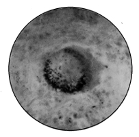 Bacillus Tuberculosis