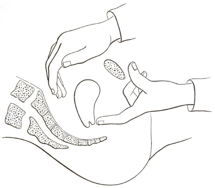 Reposition of retroverted uterus