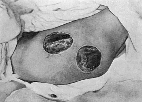 Fig. 24.—Acute Bed-Sores over Right Buttock.