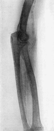 Fig. 65.—Radiogram showing Calcareous Degeneration (Atheroma) of Arteries.