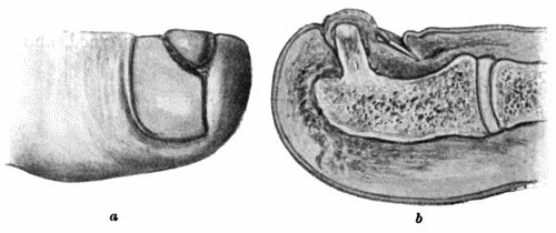 Fig. 107.—Subungual Exostosis growing from Distal Phalanx of Great Toe, showing Ulceration of Skin and Displacement of Nail. a. Surface view. b. On section.