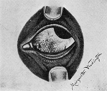 41. (a) Nodular conjunctivitis in the eye of a child.
De Schweinitz and Shumway.